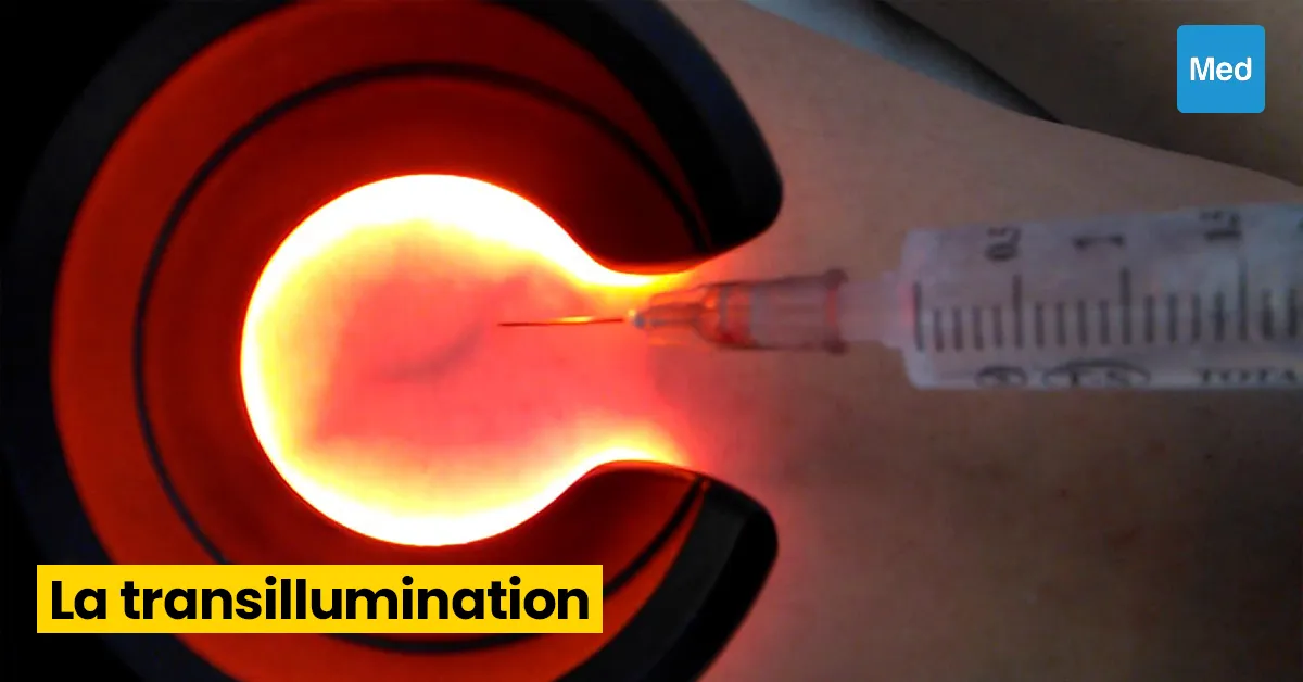 Varicosités et Telangiectasies : Comprendre et Traiter les Problèmes Veineux Cutanés